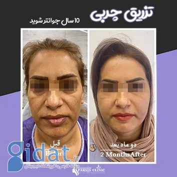 بهترین کلینیک تزریق چربی در کرج – کلینیک پارسیس